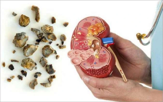obat batu ginjal,obat batu ginjal ampuh