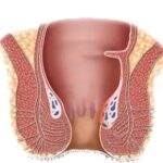 obat ambeien ambefree,obat ambeien ampuh