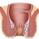 obat ambeien ambefree,obat ambeien ampuh