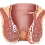 obat ambeien ambefree,obat ambeien ampuh