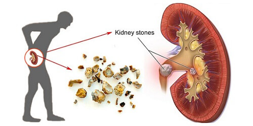 obat batu ginjal,obat batu ginjal ampuh